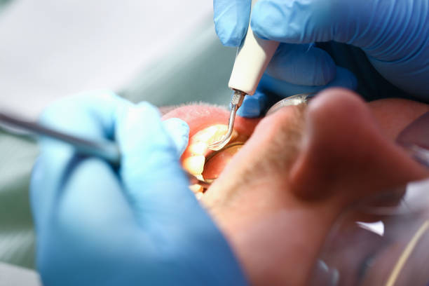 Best Broken or Cracked Tooth Emergency Dentist in North Granby, CT